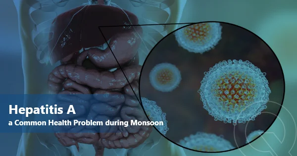 Hepatitis A: A Common Health Problem during Monsoon