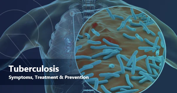 Tuberculosis – Symptoms, Treatment and Prevention