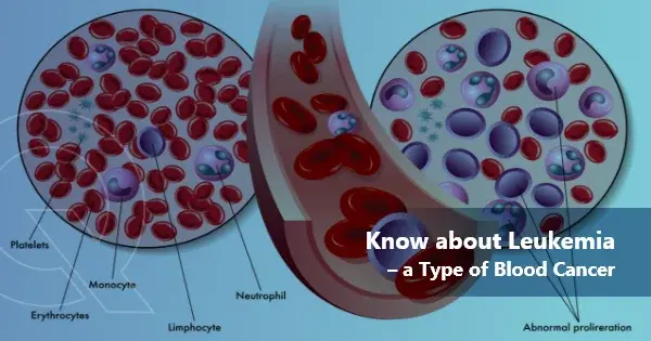 What you must know about Leukemia – a type of Blood Cancer