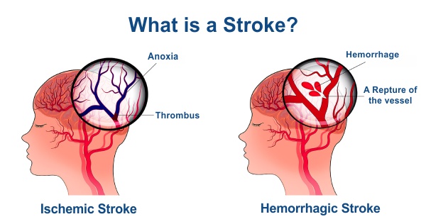 What is a Stroke?