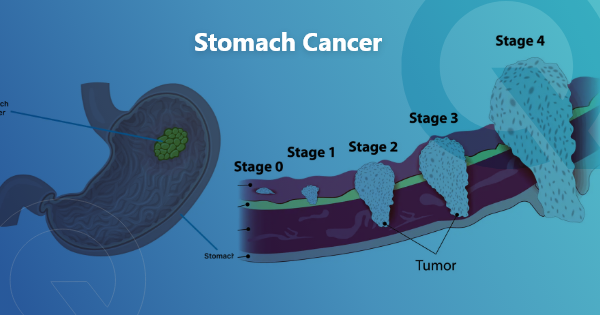 Stomach Cancer Awareness Month: Types, Tests and New Treatments