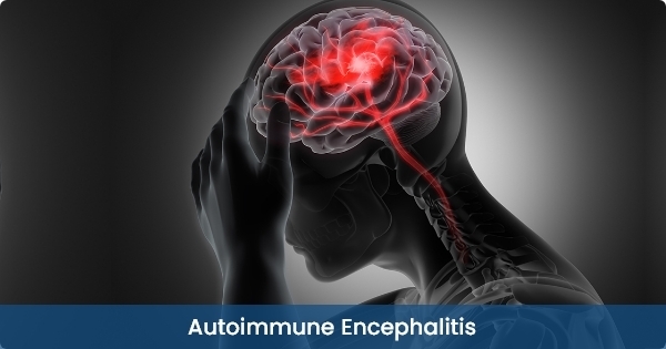 What You Need to Know About Autoimmune Encephalitis: A Guide to the Mysterious Brain Disorder