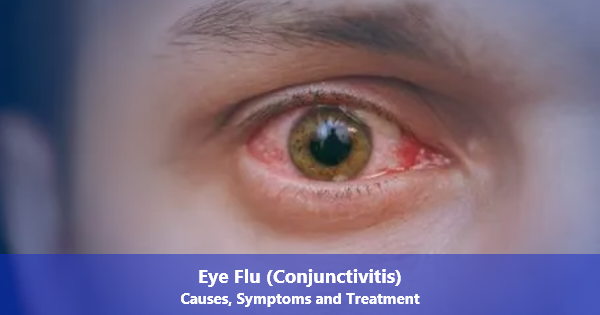Pink Eye (Conjunctivitis): Symptoms, Treatment & Self-Care