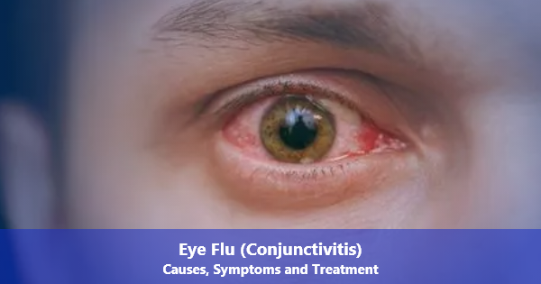 Eye Flu (Conjunctivitis): Causes, Symptoms and Treatment