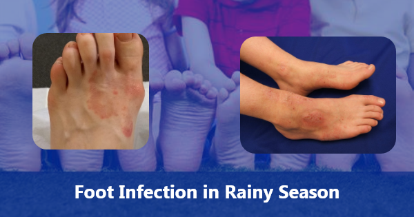 Foot Infection in Rainy Season