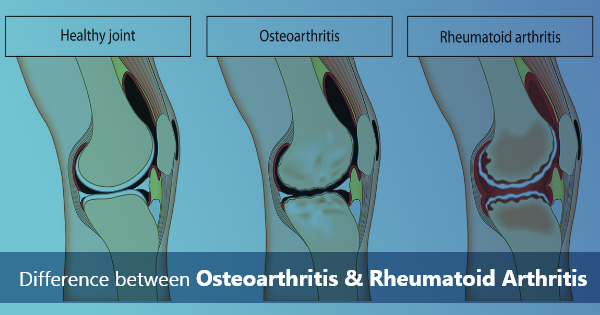 Difference Between Osteoarthritis and Rheumatoid Arthritis