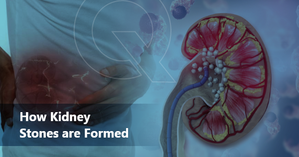 How Kidney Stones are Formed