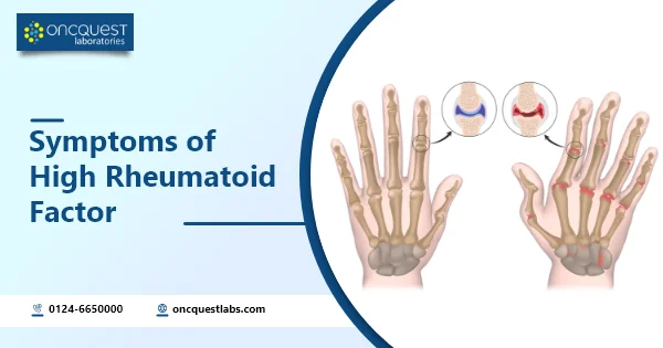 Symptoms of High Rheumatoid Factor