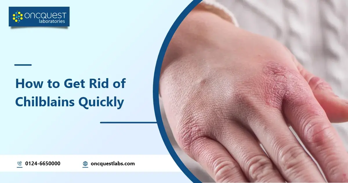 How to Get Rid of Chilblains Quickly