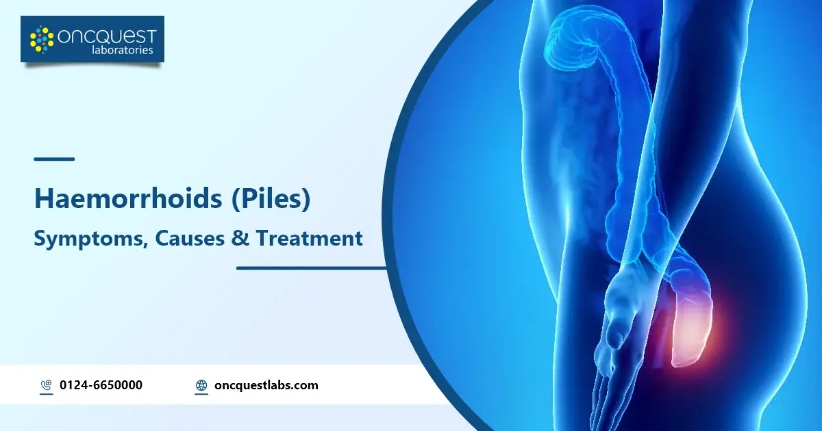 Haemorrhoids (Piles) Symptoms, Causes & Treatment