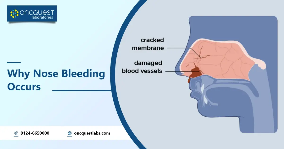 Why Nose Bleeding Occurs