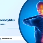 Cervical Spondylitis