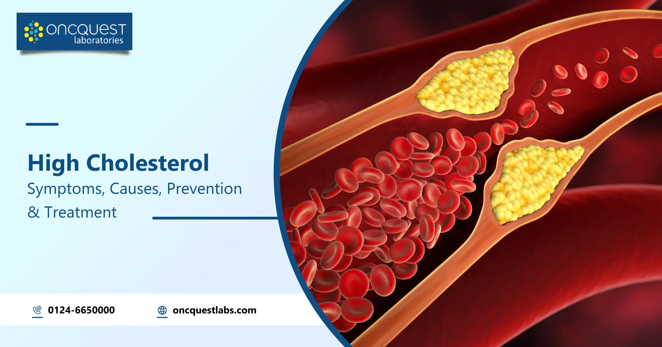 High Cholesterol: Symptoms, Causes, Prevention and Treatment