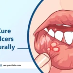 How to Cure Mouth Ulcers Fast Naturally