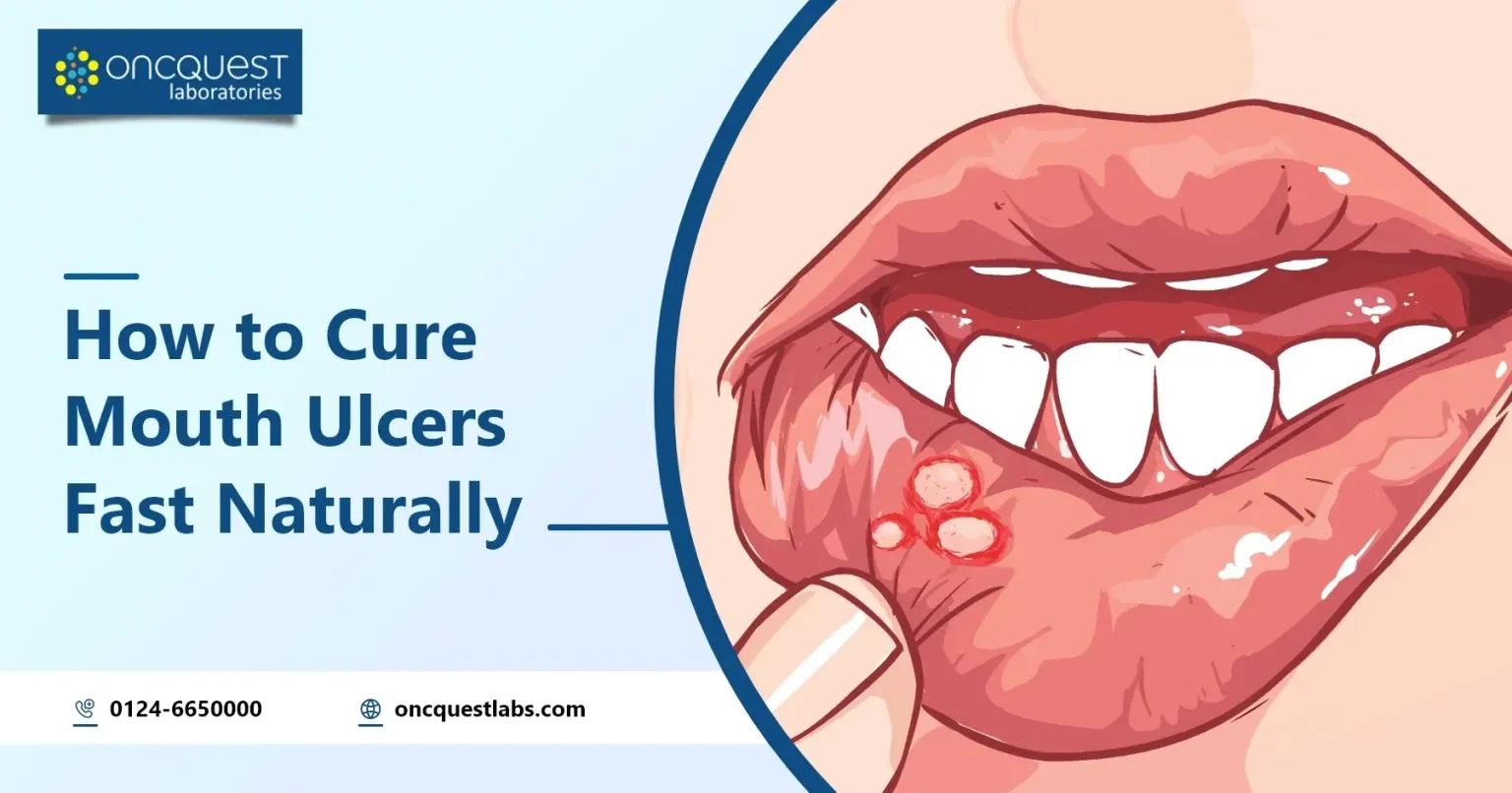 How to Cure Mouth Ulcers Fast Naturally