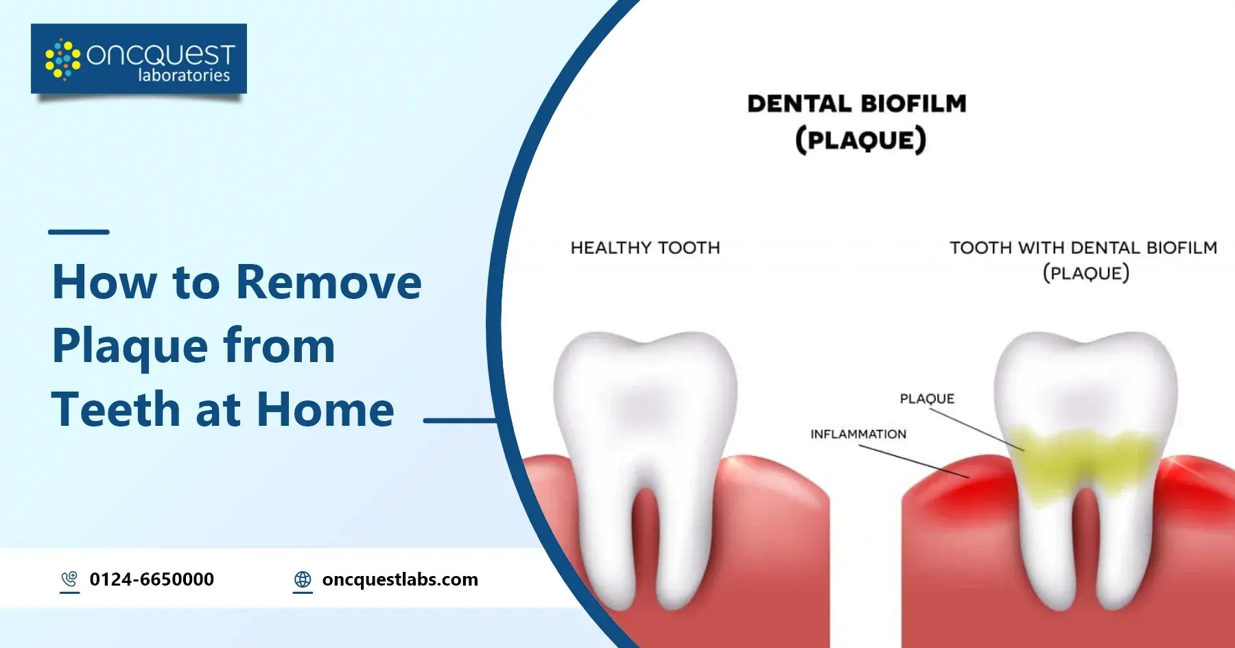 How to Remove Plaque from Teeth at Home