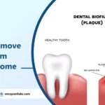 How to Remove Plaque from Teeth at Home? 