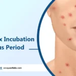 Chickenpox Incubation and Infectious Period