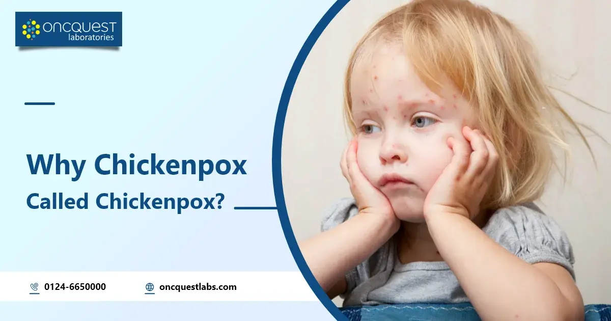 Why Chickenpox is Called Chickenpox | Oncquest Blog- Your Health Guide