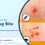 Home Remedies for Insect-Bug Bite