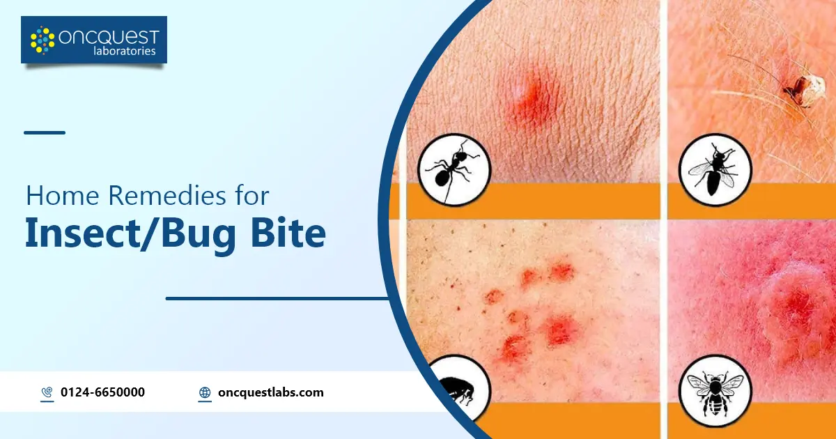 Home Remedies for Bug Bites and Insect