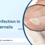 Fungal Infection in Fingernails