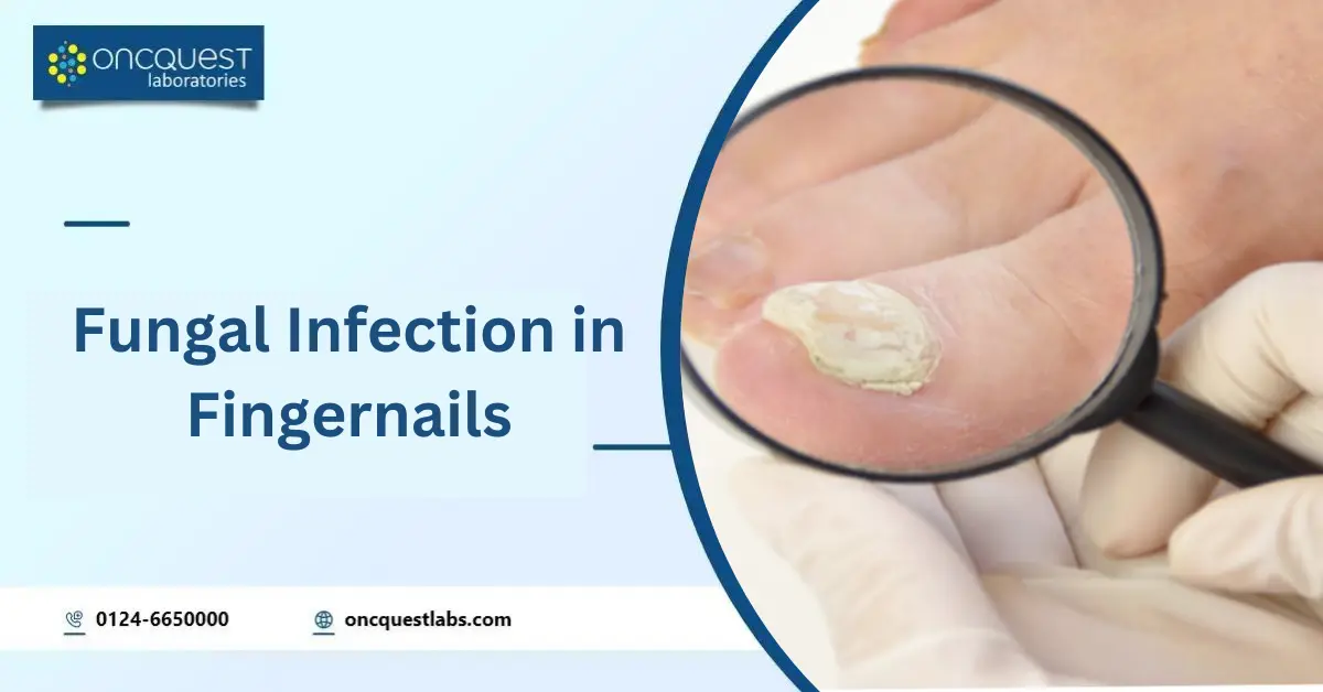 Fungal Infection in Fingernails