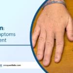 gigantism causes, symptoms and treatment