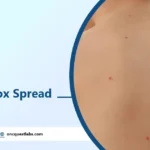 How Does Chickenpox Spread