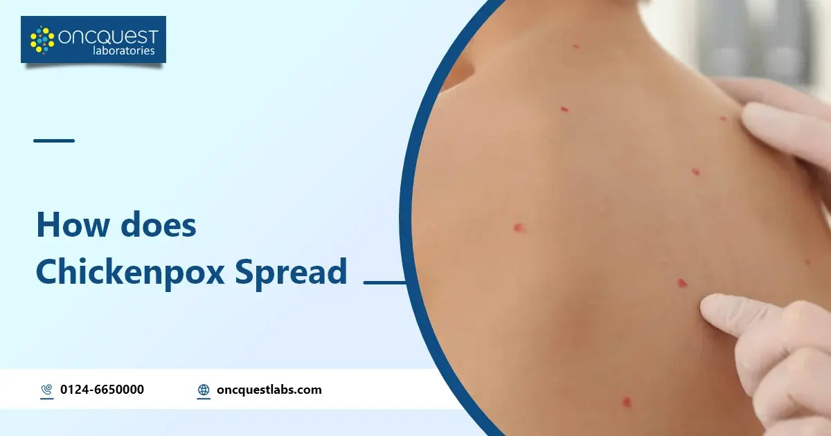 How Does Chickenpox Spread