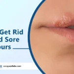 How to Get Rid of a Cold Sore in 24 Hours?