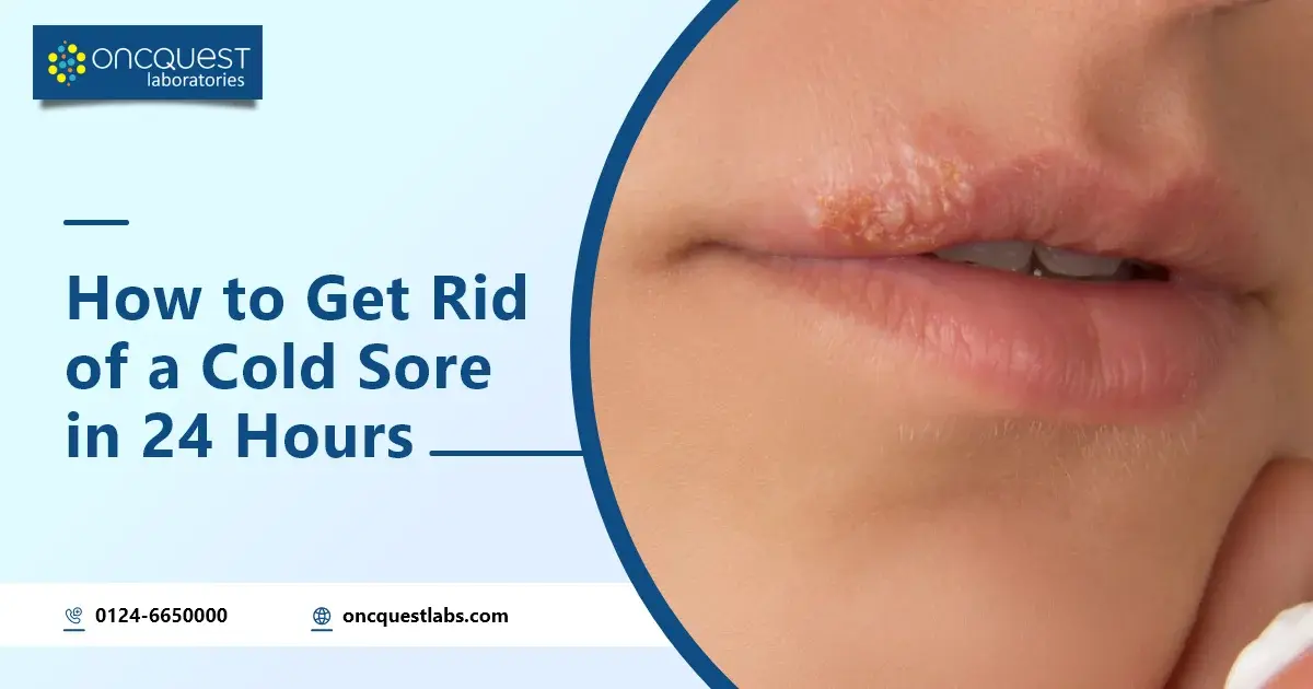 How to Get Rid of a Cold Sore in 24 Hours?